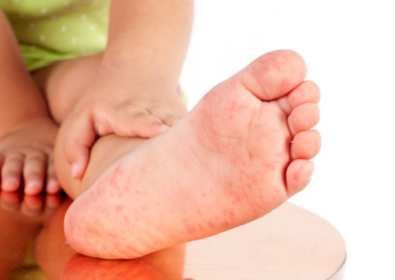 Сыпь на ладонях и ступнях ребенка - причины с фото и лечение